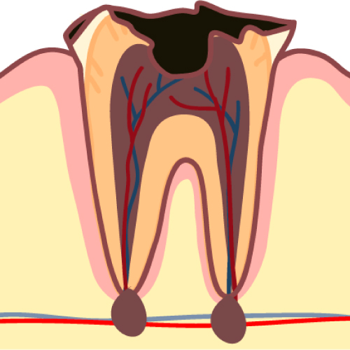 根管治療とは